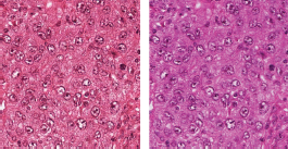 A micrograph showing two distinct tissue samples side by side.