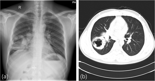 Two chest images labelled a and b showing a P A radiograph and an axial C T scan with a cavitary lesion in the right lung.