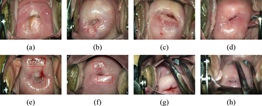 Eight intraoperative cervical images labelled a to h showing cervical o s appearance before, during, and after surgical manipulation.