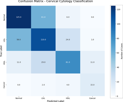 Confusion matrix for cervical cytology classification showing counts for Normal, L S I L, H S I L, and Cancer predictions.