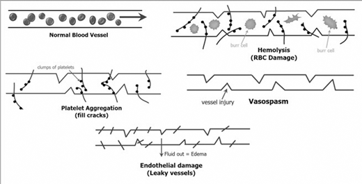Diagram showing five different conditions in blood vessels: Normal, Hemolysis, Platelet Aggregation, Vasospasm, and Endothelial damage.
