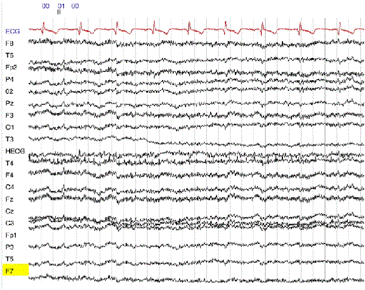 Figure 2 A EEG brain data acquisition generated in a typical experiment.